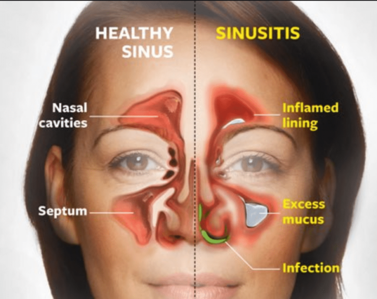 Lymphatic Drainage and Massage Can Help Relieve Sinus Congestion